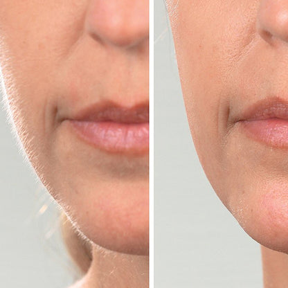 DermaQueen Vibra-Sonic® Depilación y Exfoliante Dermaplane